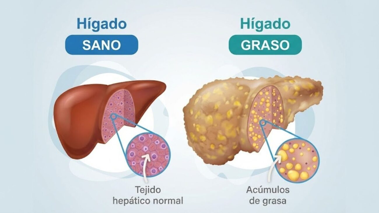 El hígado graso es una condición cada vez más frecuente en la consulta médica, pero es vital distinguir sus variantes. Mientras una está ligada al consumo excesivo de alcohol, hoy nos centraremos en el Hígado Graso No Alcohólico (HGNA). Esta patología afecta a personas que beben poco o nada de alcohol, siendo el resultado directo de un desequilibrio en el estilo de vida moderno.